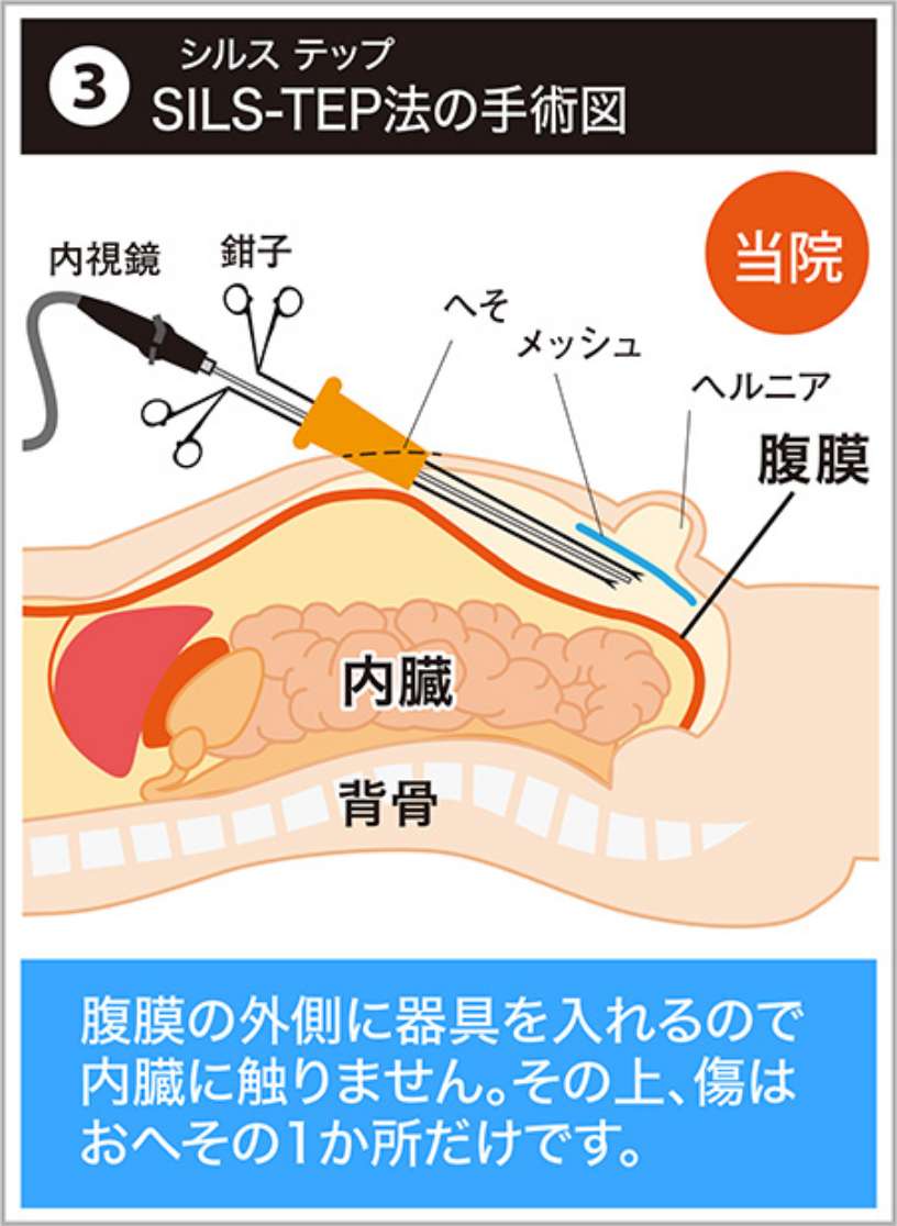 SILS-TEP法の手術図 腹膜の外側に器具を入れるので内臓に触りません。その上、傷はおへその1か所だけです。