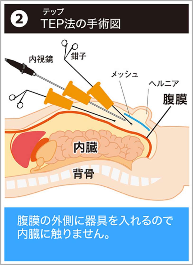 TEP法の手術図 腹膜の外側に器具を入れるので内臓に触りません。