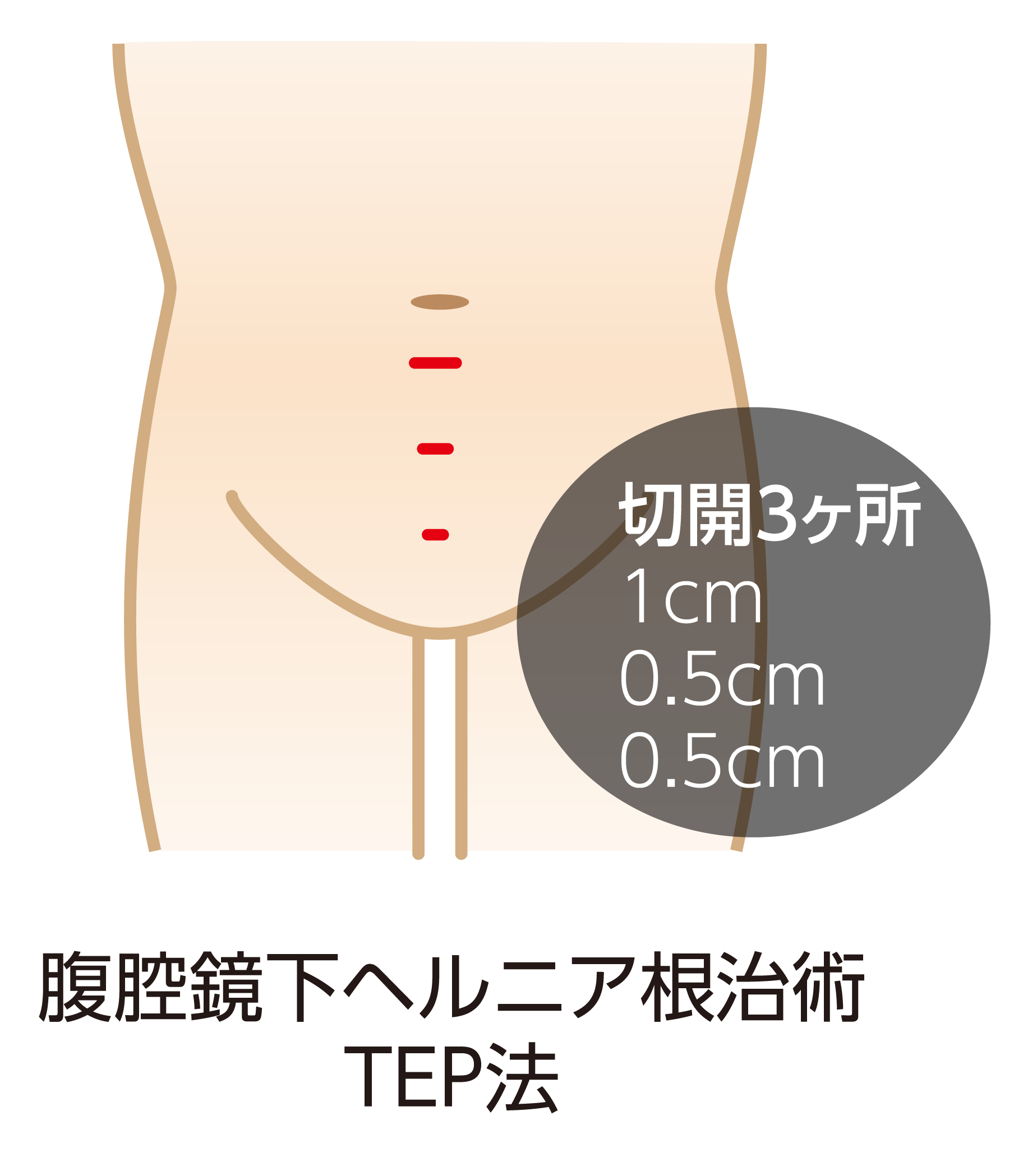 切開3ヶ所 1cm 0.5cm 0.5cm 腹腔鏡下ヘルニア根治術TEP法