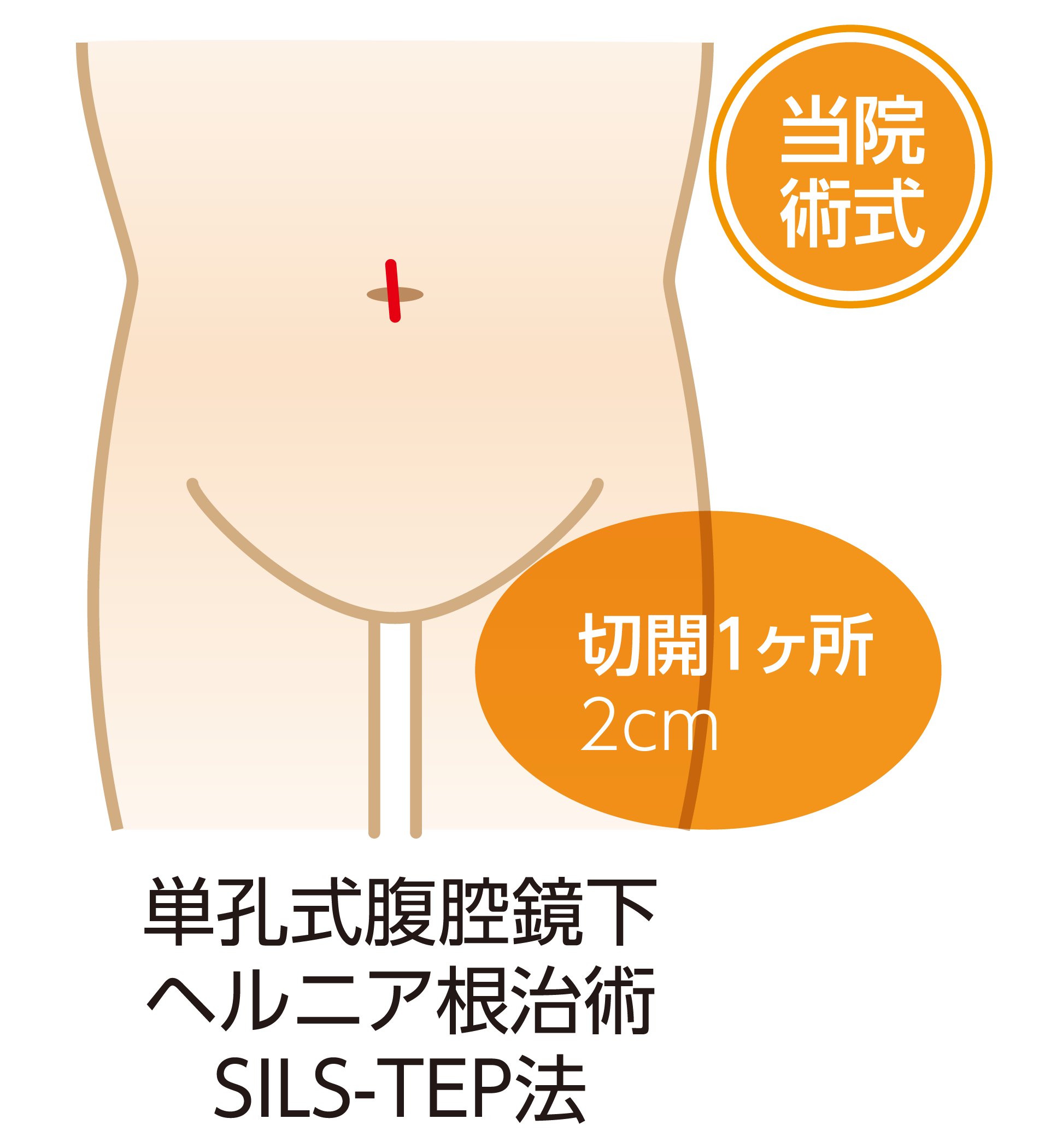 当院術式 切開1ヶ所 2cm 単孔式腹腔鏡下鼠径ヘルニア根治術(SILS-TEP法)